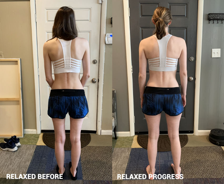 Pectus excavatum, poor posture, scoliosis, back pain - Chattanooga, Nashville, Atlanta, Cleveland