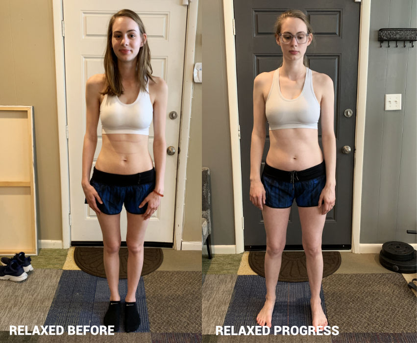 Pectus excavatum, scoliosis, back pain, neck pain results - Chattanooga